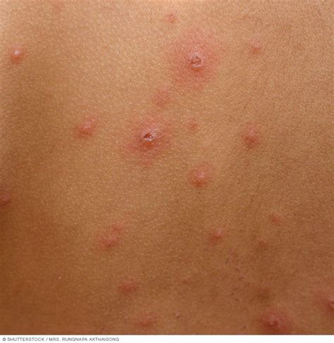 Chickenpox .